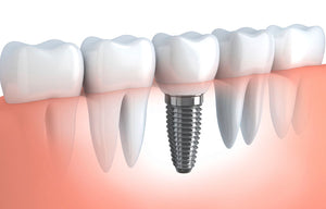 Implant Dentistry in Edison NJ