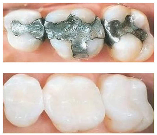 Composite (White) Fillings