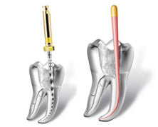 Endodontics (Root Canal Therapy)