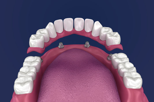 Full-Mouth Reconstruction