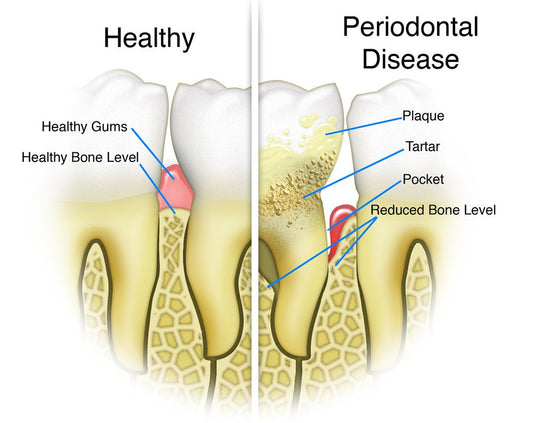 Periodontal Care (Scaling and Root Planing)