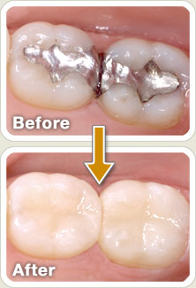 Composite (White) Fillings