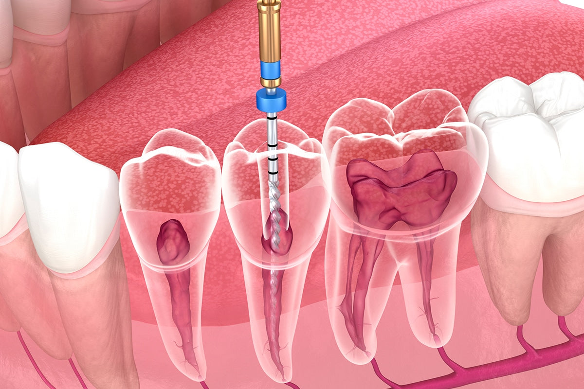 Endodontics (Root Canal Therapy)