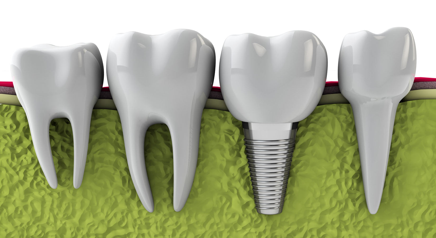 Implant Dentistry | Dentist in Edison NJ (New Jersey) Area